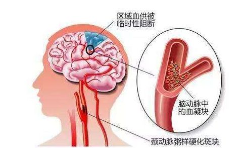 突发警报！脑梗发作前身体三大部位悄然变化，硬化迹象显露无疑！