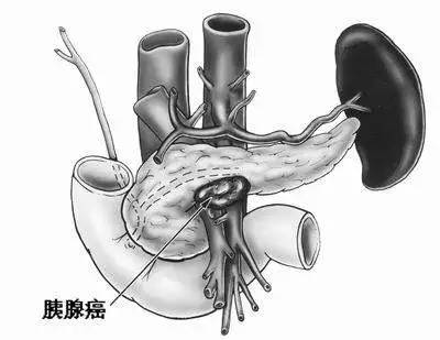 苏州成功实施首例胰腺癌疫苗手术，打破癌症治疗新篇章！未来何去何从？悬念重重揭晓。